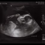Symptomy związane z obecnością mięśniaków w macicy
