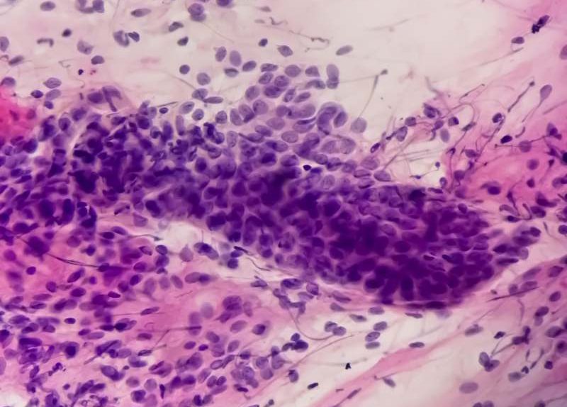 Analiza moczu u przyszłych mam - rezultaty i osad